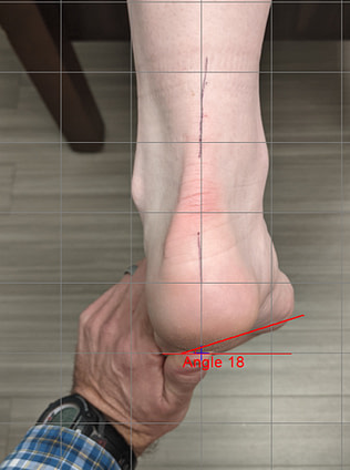 STN testing on table A foot exam is showing a neutral heel position but an 18 degree varus forefoot.