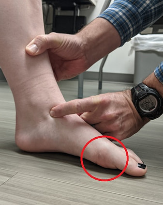 STN testing seated The same foot during a seated test reveals no contact between the first ray and the ground.