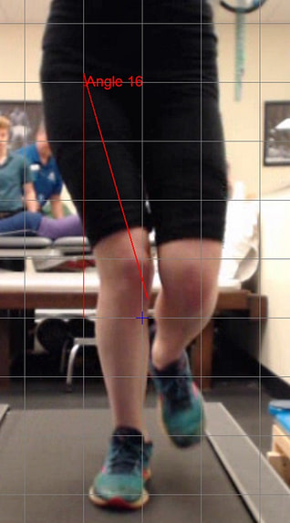 a picture from a gait analysis shows a runner in mid-stance on the right leg with significant medial deviation of the knee.